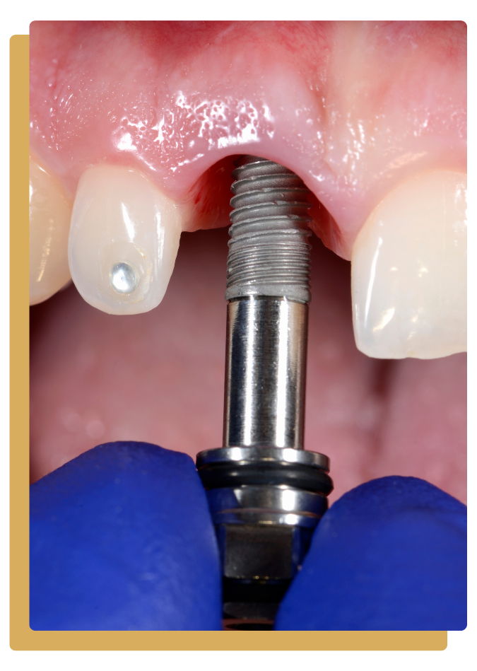 implantes-dentales-en-osorno