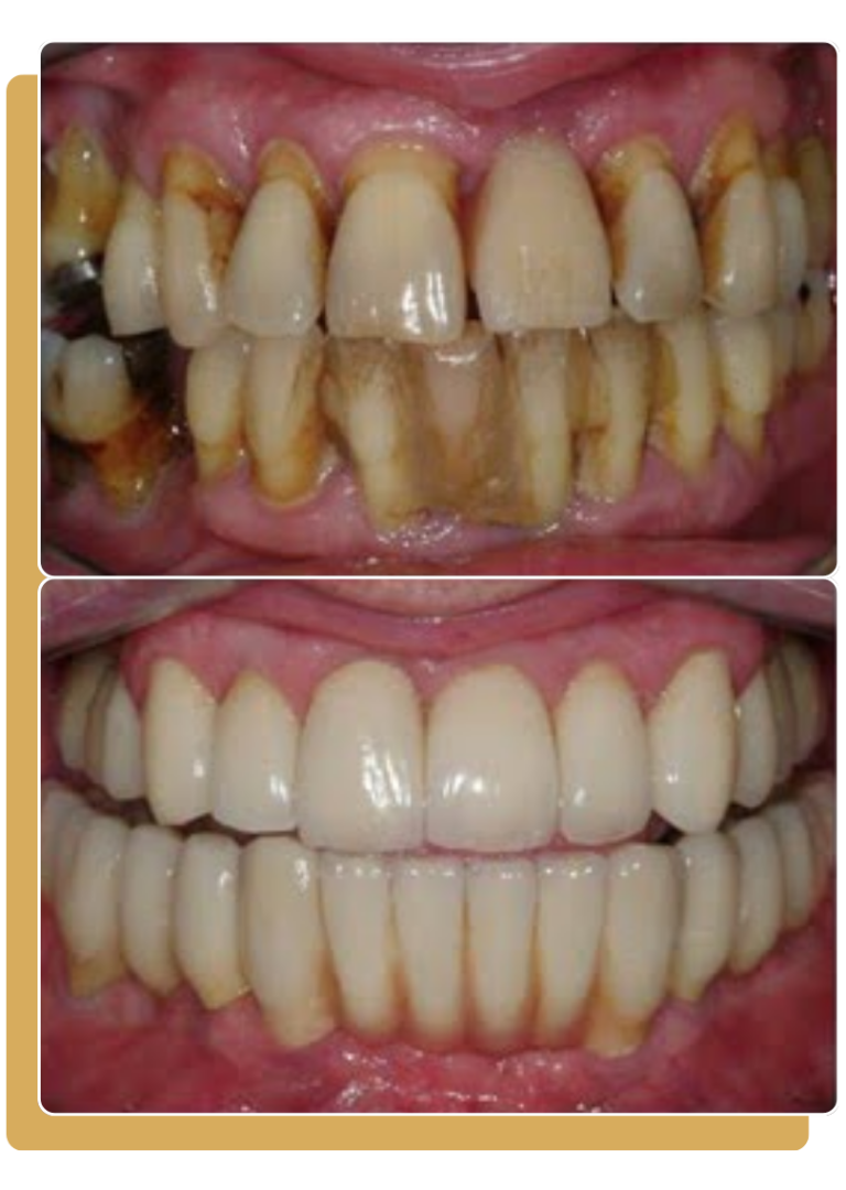 Tratamiento de periodoncia en Osorno - cuidado de encías en Clínica Montecarlo
