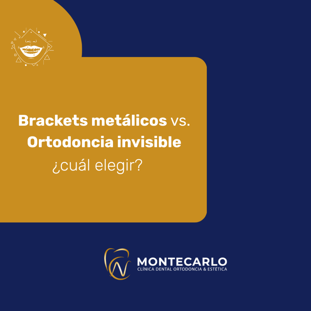 Ortodoncia-Invisible-metalica-en-osorno